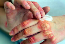 Photo of फंगल इन्फेक्शन सिर्फ़ मानसून की समस्या नहीं — सर्दियों में स्किन केयर आपकी सोच से कहीं ज़्यादा ज़रूरी है