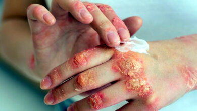 Photo of फंगल इन्फेक्शन सिर्फ़ मानसून की समस्या नहीं — सर्दियों में स्किन केयर आपकी सोच से कहीं ज़्यादा ज़रूरी है